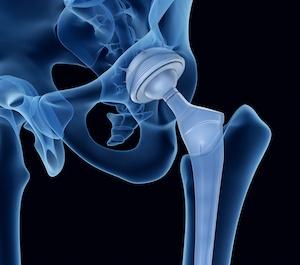 Strker Hip Replacement